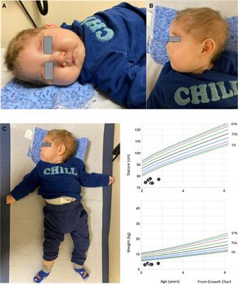 Frontiers | case report: a new case of yars1-associated autosomal